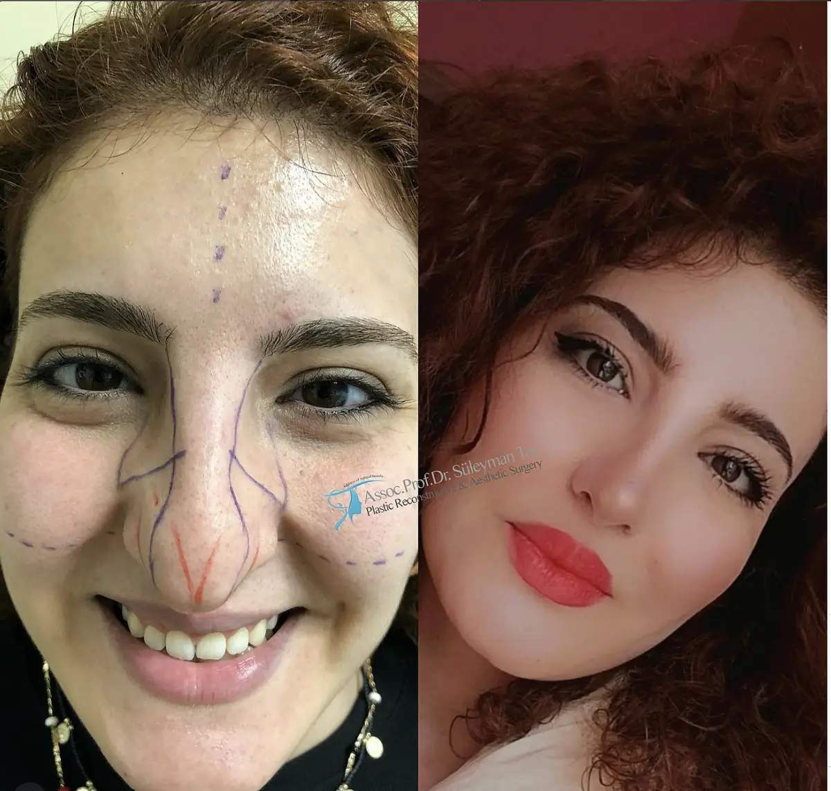 Suleyman Tas reviews – verified rhinoplasty patient review #125