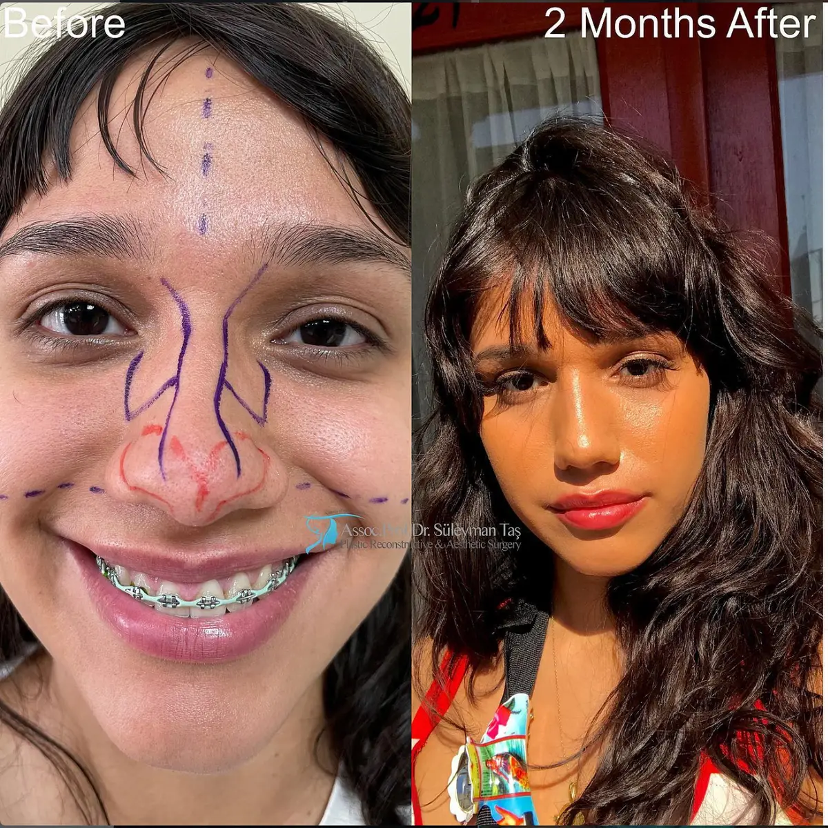 Suleyman Tas reviews – verified rhinoplasty patient review #98