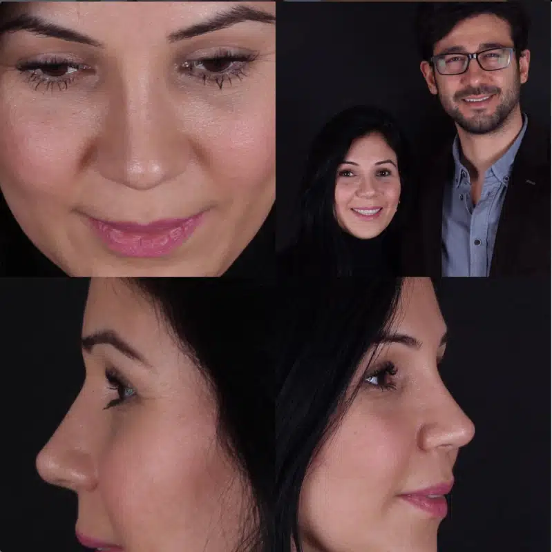 Suleyman Tas reviews – verified rhinoplasty patient review #242