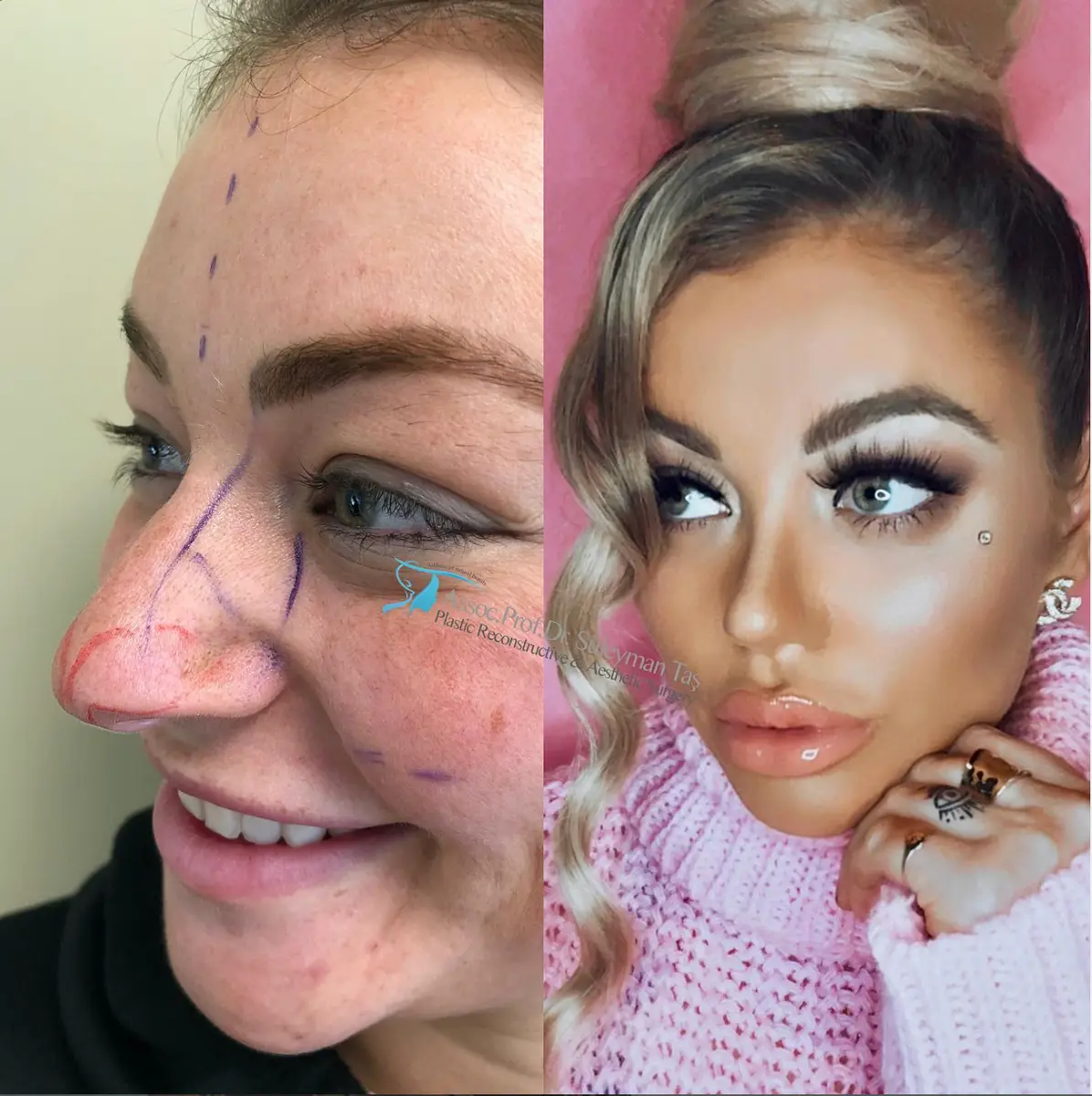 Suleyman Tas reviews – verified rhinoplasty patient review #150 (photo 1)
