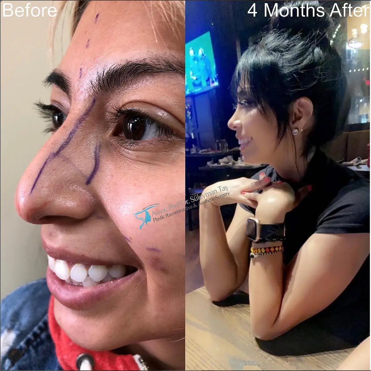 Suleyman Tas reviews – verified rhinoplasty patient review #107 (photo 2)