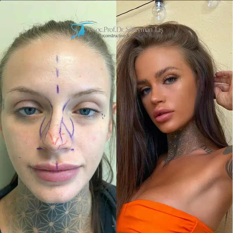 Suleyman Tas reviews – verified rhinoplasty patient review #184 (photo 1)