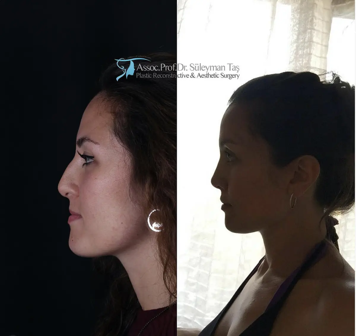 Suleyman Tas reviews – verified rhinoplasty patient review #165