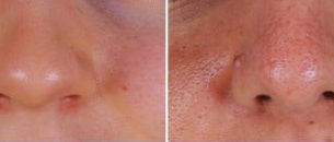 How Skin Type Affects Your Rhinoplasty Results