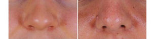 How Skin Type Affects Your Rhinoplasty Results
