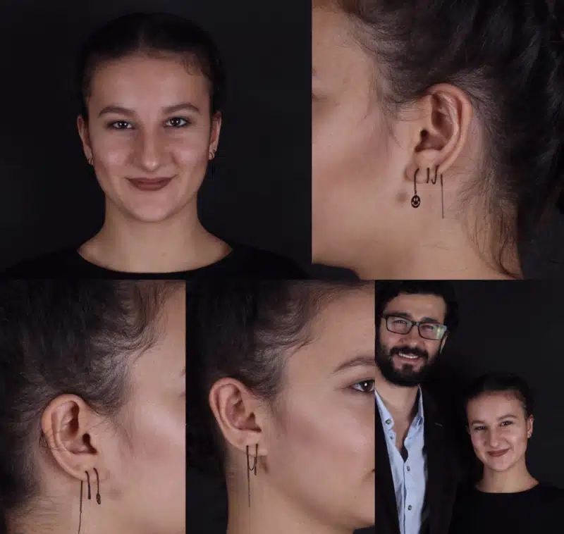 Suleyman Tas reviews – verified rhinoplasty patient review #243