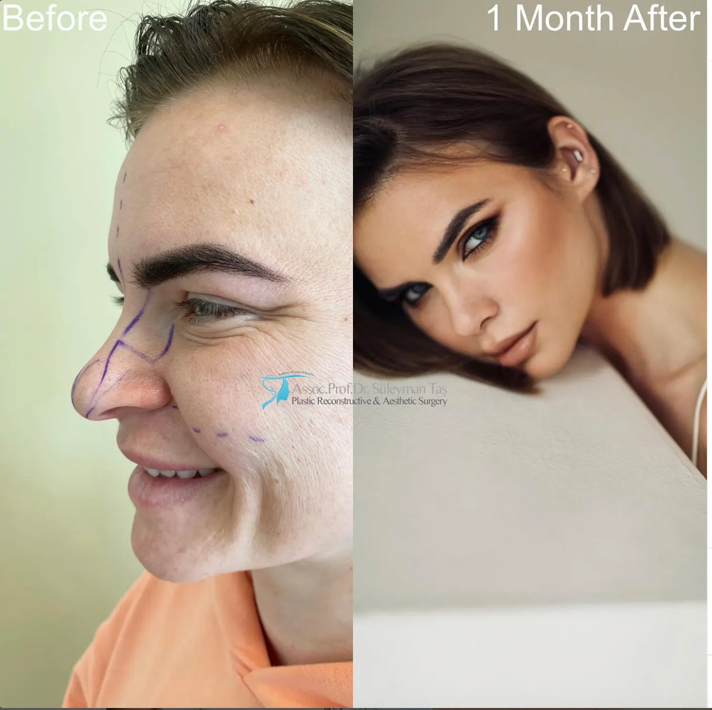 Suleyman Tas reviews – verified rhinoplasty patient review #67