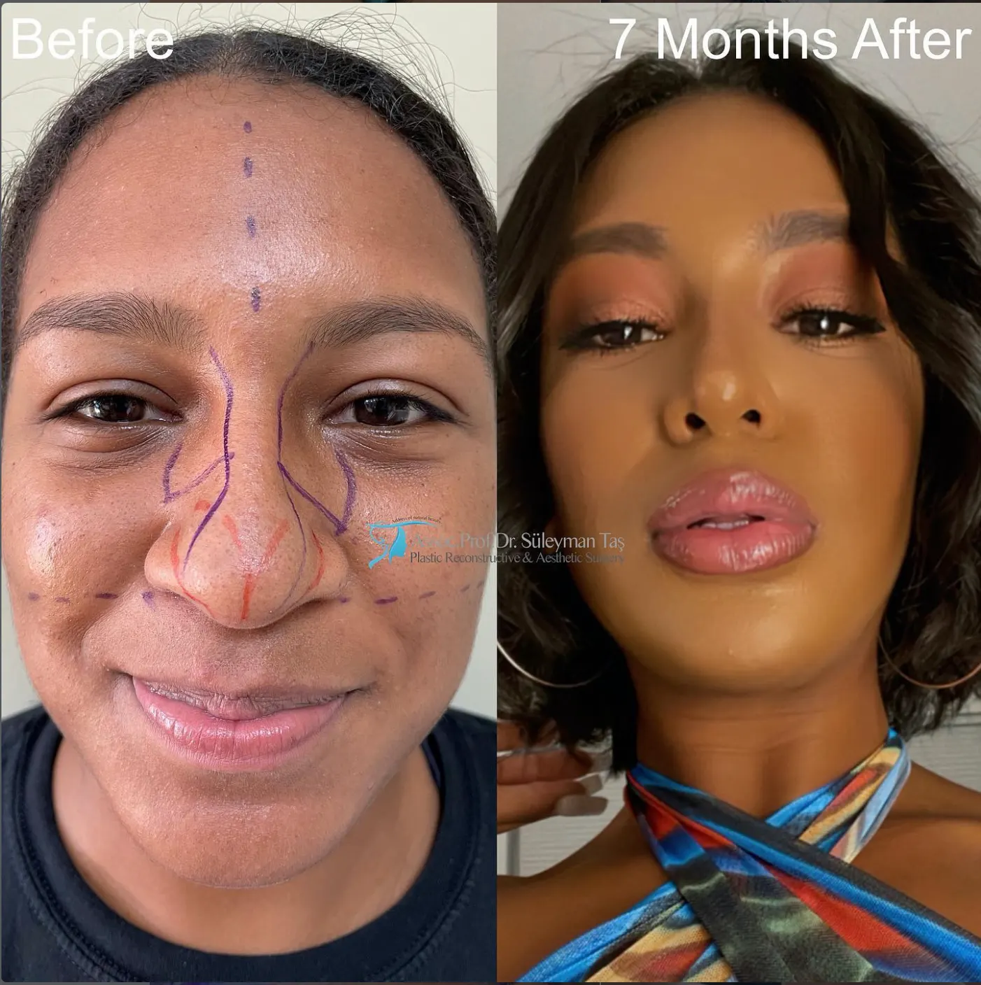 Suleyman Tas reviews – verified rhinoplasty patient review #64