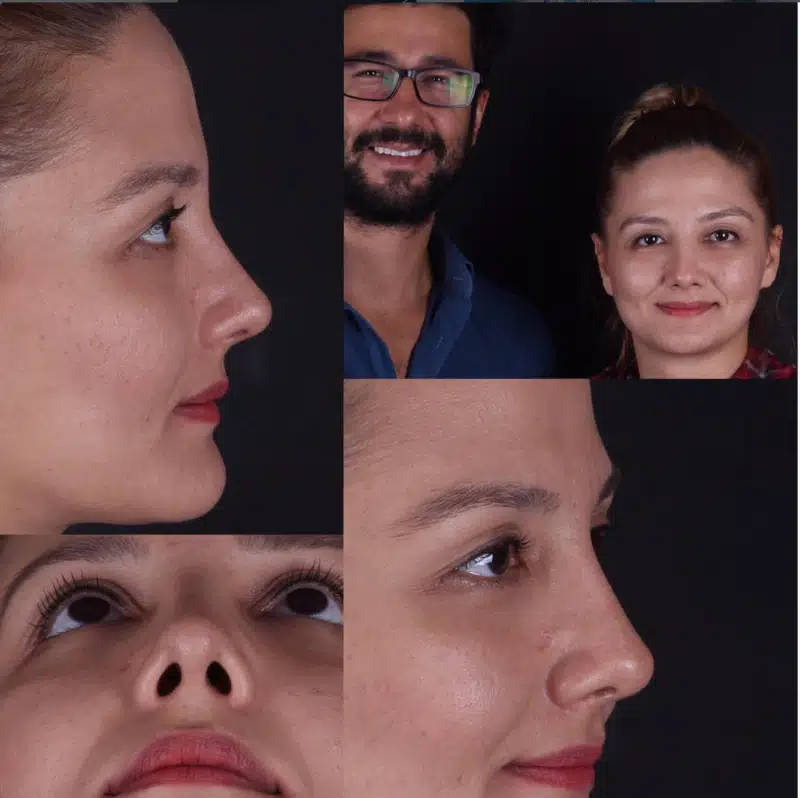 Suleyman Tas reviews – verified rhinoplasty patient review #283