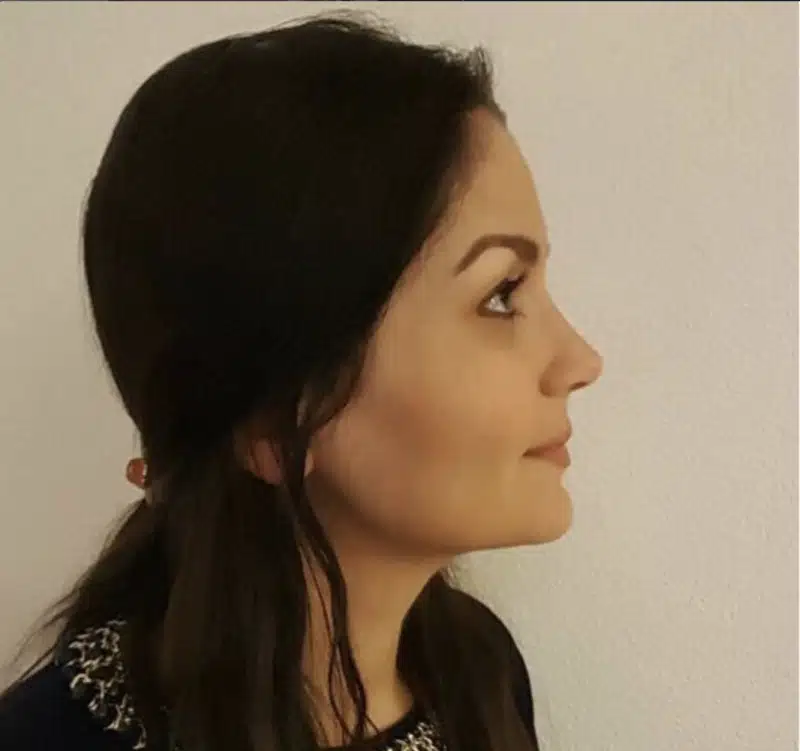 Suleyman Tas reviews – verified rhinoplasty patient review #263
