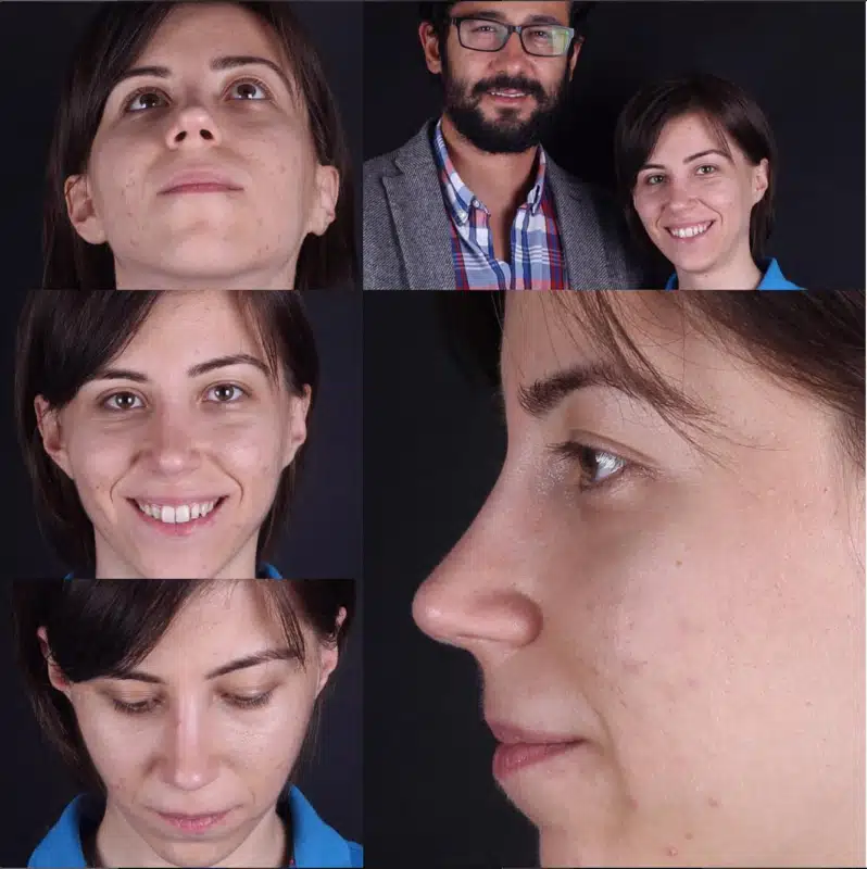 Suleyman Tas reviews – verified rhinoplasty patient review #277