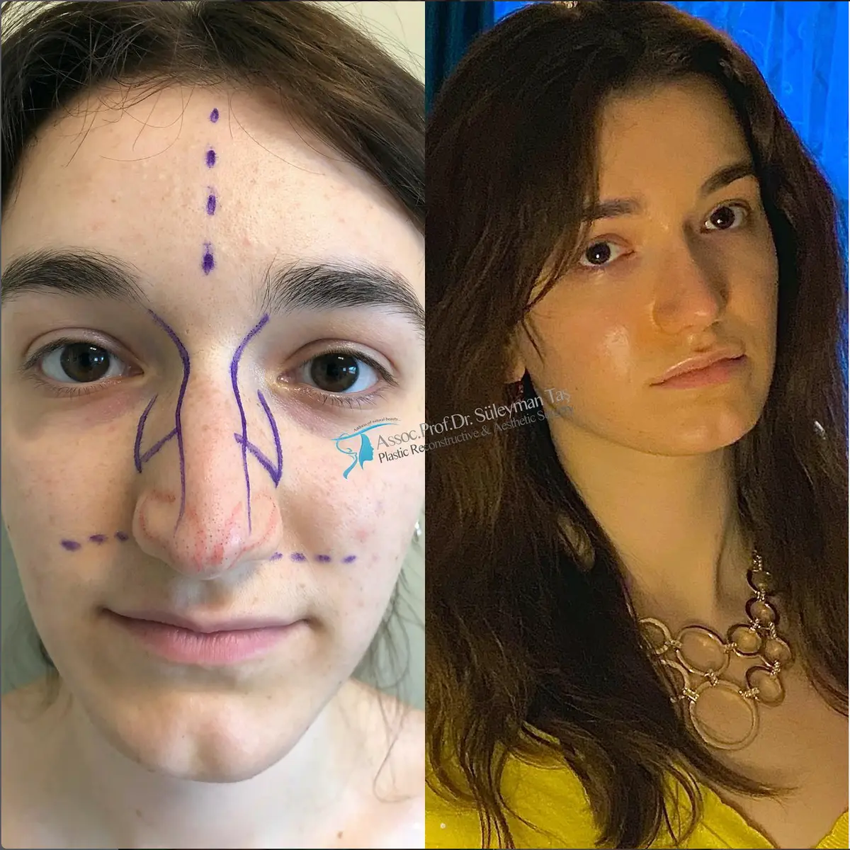 Suleyman Tas reviews – verified rhinoplasty patient review #153 (photo 1)
