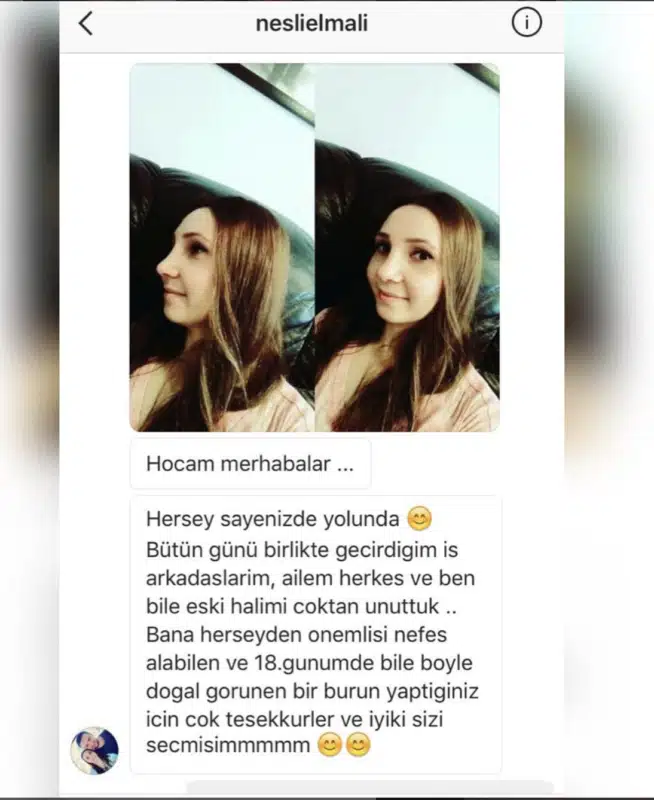 Suleyman Tas reviews – verified rhinoplasty patient review #291