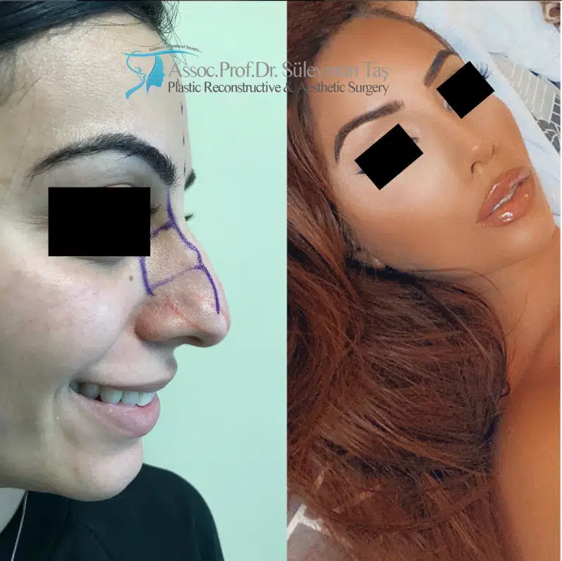 Suleyman Tas reviews – verified rhinoplasty patient review #190 (photo 3)