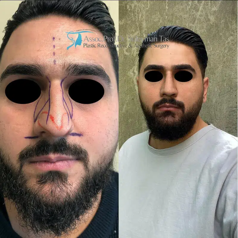Suleyman Tas reviews – verified rhinoplasty patient review #170 (photo 2)