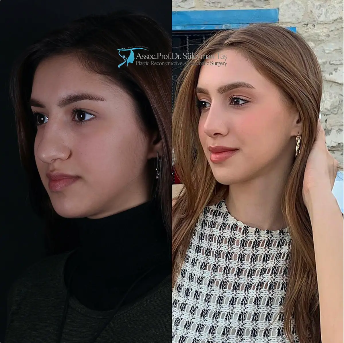 Suleyman Tas reviews – verified rhinoplasty patient review #167 (photo 2)