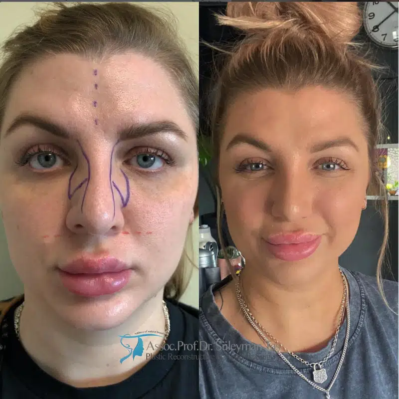 Suleyman Tas reviews – verified rhinoplasty patient review #178 (photo 1)