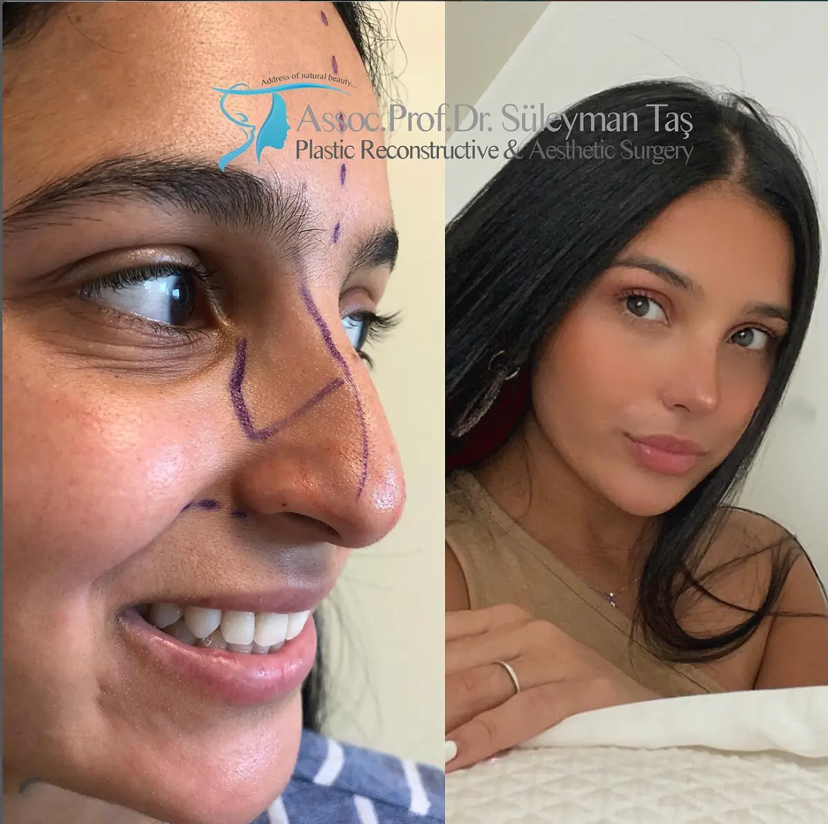 Suleyman Tas reviews – verified rhinoplasty patient review #164 (photo 2)