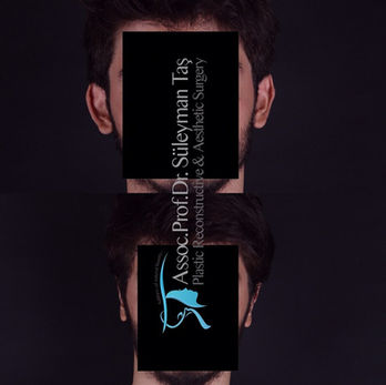 Otoplasty (Ear Pinning) before and after photo of a male patient, front view, by Prof. Dr. Süleyman Taş, plastic surgeon in Istanbul