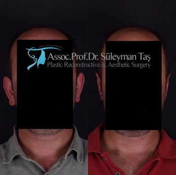 Otoplasty (Ear Pinning) before and after photo of a male patient, front view, by Prof. Dr. Süleyman Taş, plastic surgeon in Istanbul