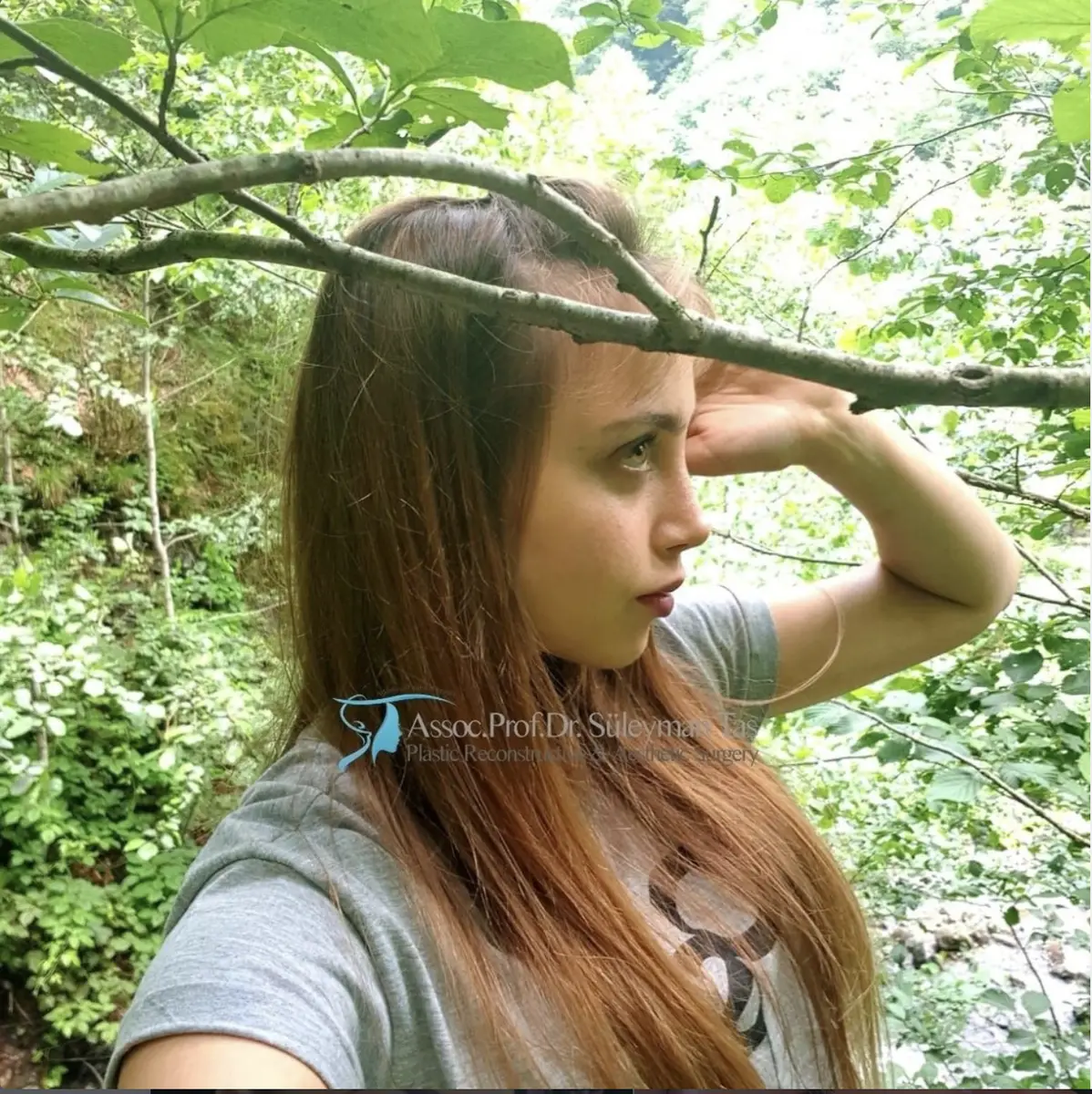 Suleyman Tas reviews – verified rhinoplasty patient review #122