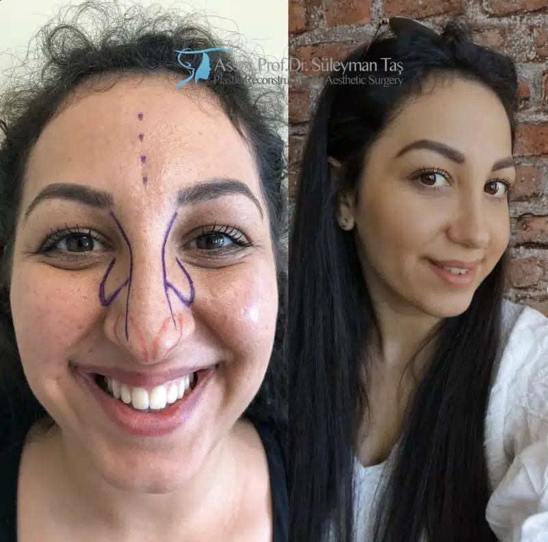 Suleyman Tas reviews – verified rhinoplasty patient review #183 (photo 3)
