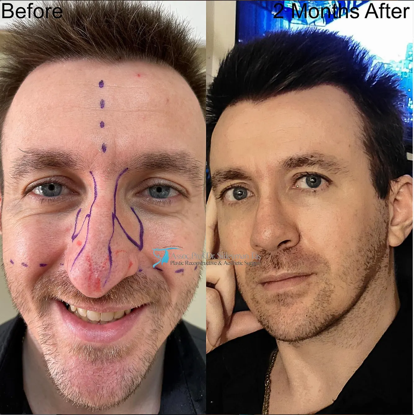 Suleyman Tas reviews – verified rhinoplasty patient review #90 (photo 2)