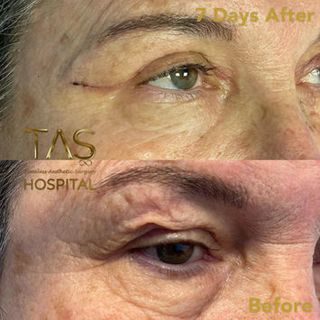 Blepharoplasty (Eyelid Surgery) before and after photo of a female patient, front view, by Prof. Dr. Süleyman Taş, plastic surgeon in Istanbul