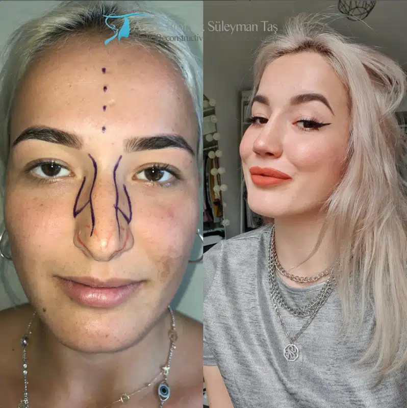 Suleyman Tas reviews – verified rhinoplasty patient review #182 (photo 1)