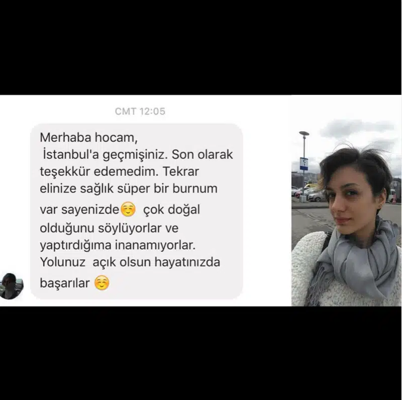 Suleyman Tas reviews – verified rhinoplasty patient review #342