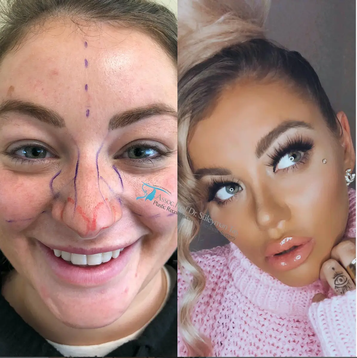 Suleyman Tas reviews – verified rhinoplasty patient review #150 (photo 3)