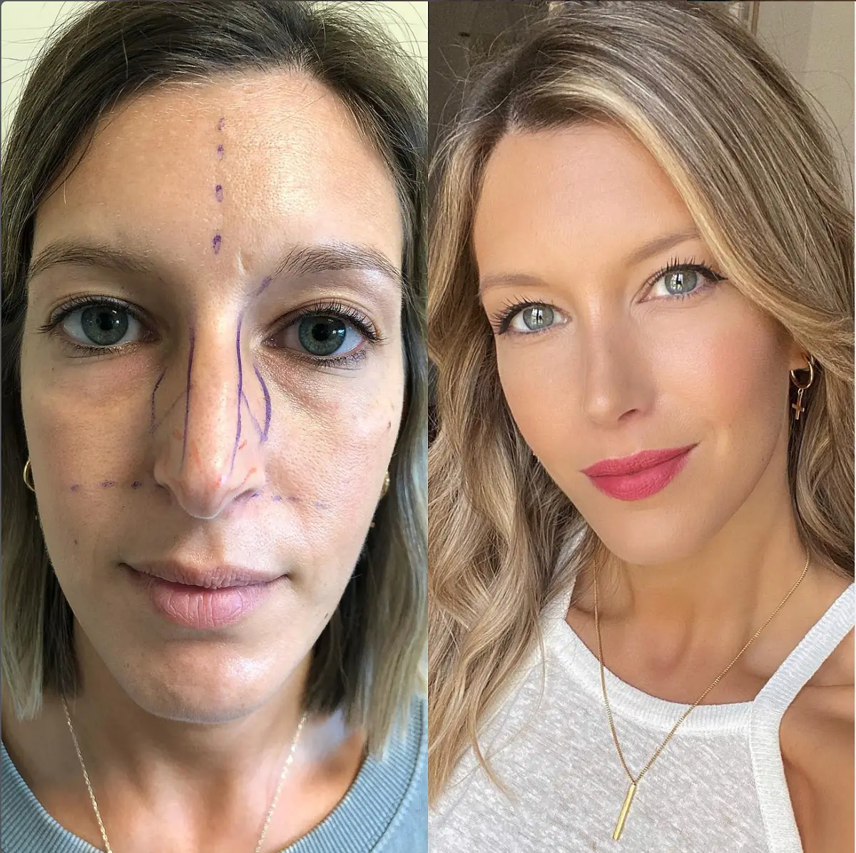 Suleyman Tas reviews – verified rhinoplasty patient review #99 (photo 4)