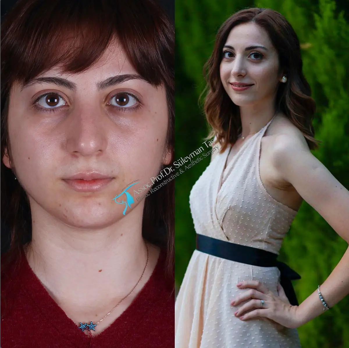 Suleyman Tas reviews – verified rhinoplasty patient review #168 (photo 2)