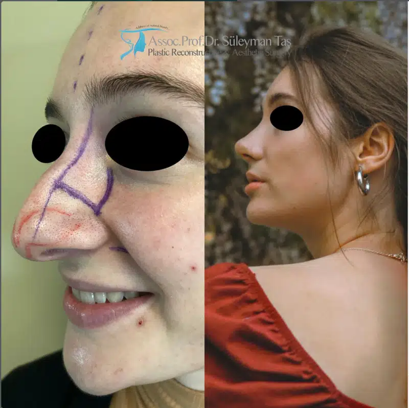 Suleyman Tas reviews – verified rhinoplasty patient review #171 (photo 3)