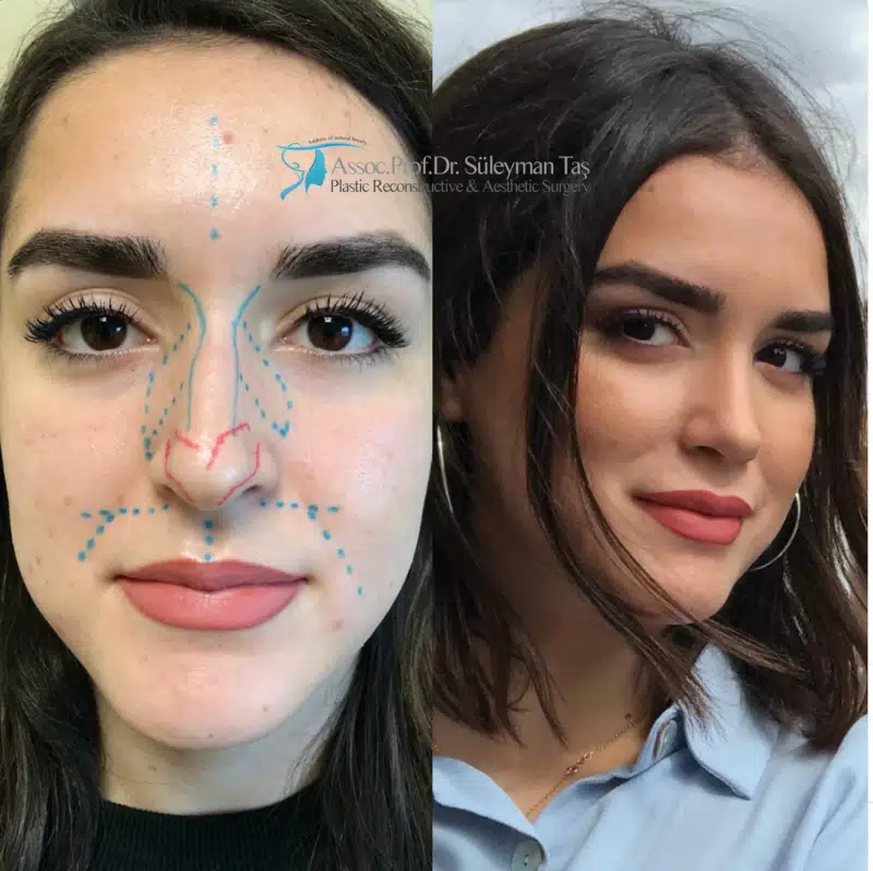 Suleyman Tas reviews – verified rhinoplasty patient review #172 (photo 1)