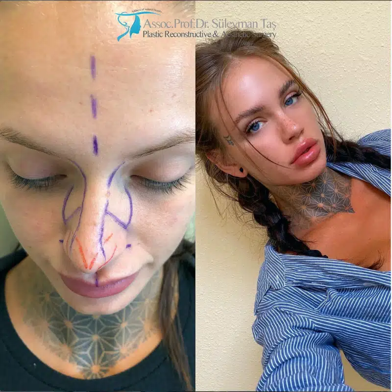 Suleyman Tas reviews – verified rhinoplasty patient review #184 (photo 3)
