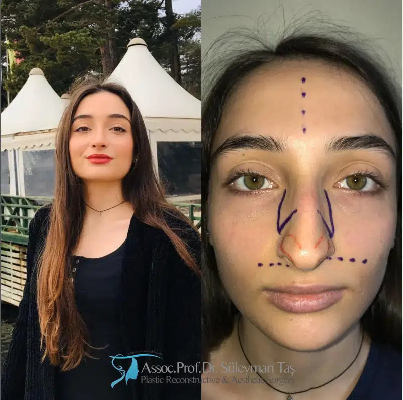Suleyman Tas reviews – verified rhinoplasty patient review #179 (photo 3)