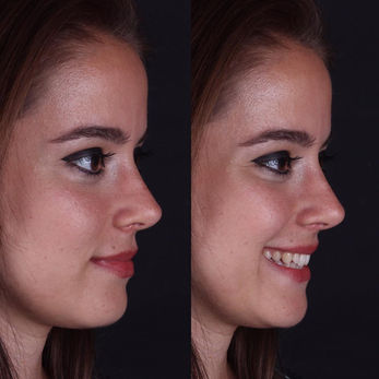 Revision Rhinoplasty before and after photo of a female patient, side profile view, by Prof. Dr. Süleyman Taş, plastic surgeon in Istanbul
