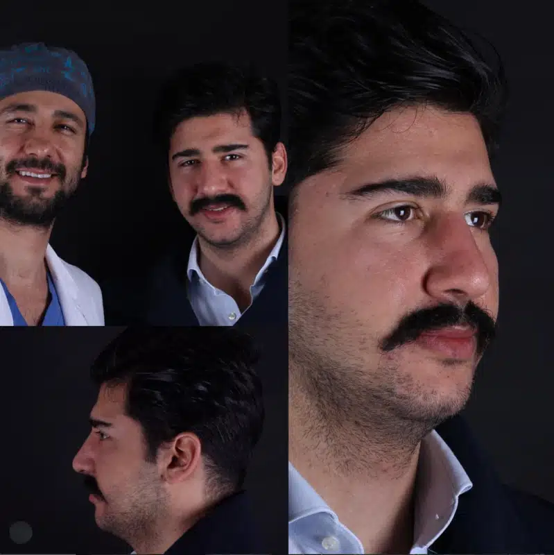 Suleyman Tas reviews – verified rhinoplasty patient review #341