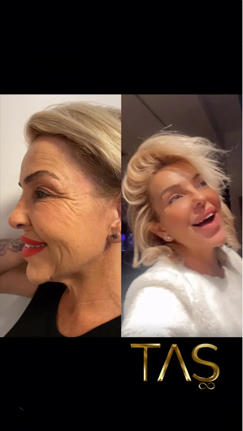 Suleyman Tas reviews – verified facelift patient review #12