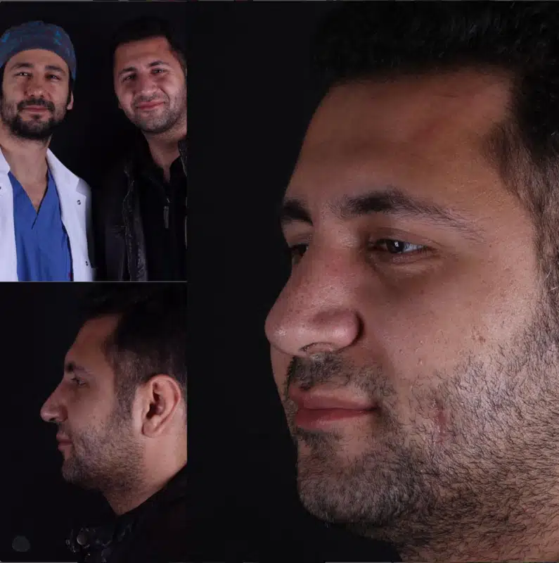 Suleyman Tas reviews – verified rhinoplasty patient review #345