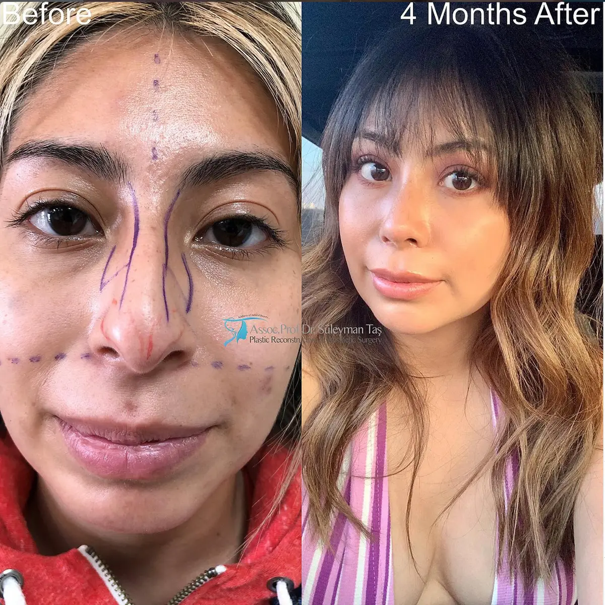 Suleyman Tas reviews – verified rhinoplasty patient review #107 (photo 3)