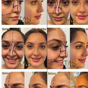 Rhinoplasty Expectations: What Really Predicts Happiness