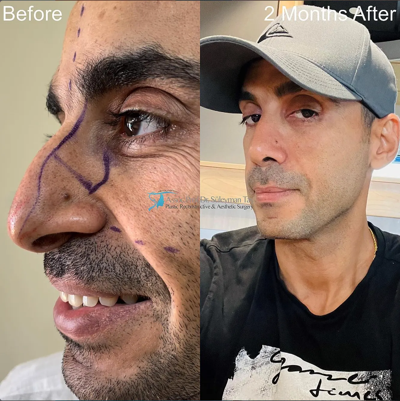 Suleyman Tas reviews – verified rhinoplasty patient review #60 (photo 2)