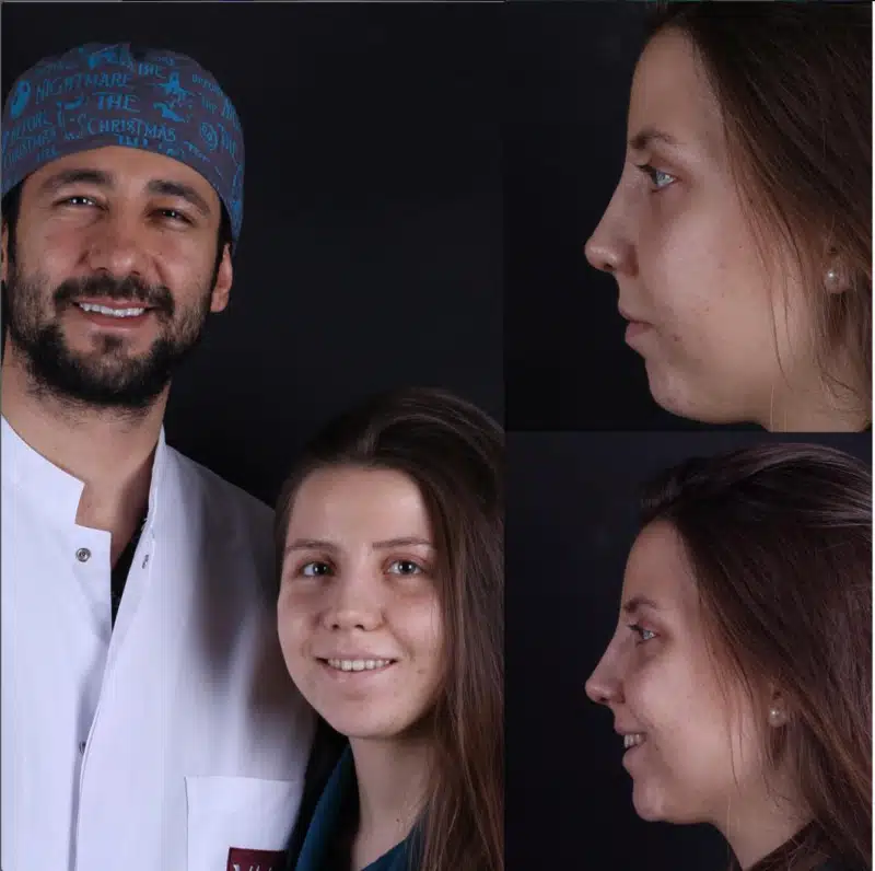 Suleyman Tas reviews – verified rhinoplasty patient review #348