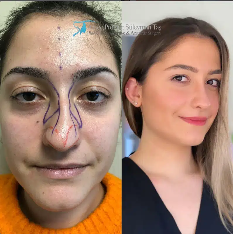 Suleyman Tas reviews – verified rhinoplasty patient review #176