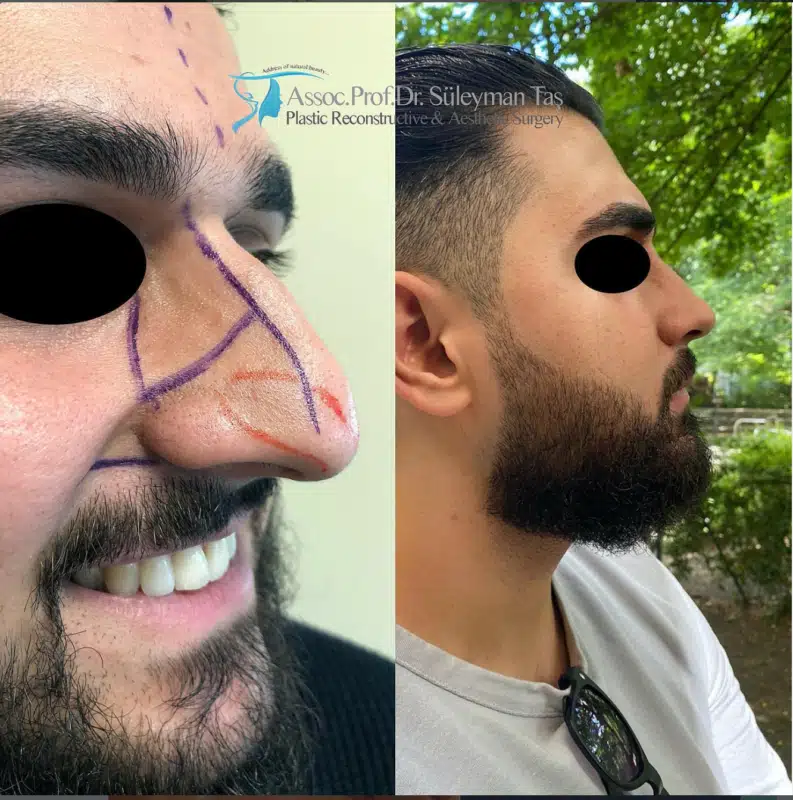 Suleyman Tas reviews – verified rhinoplasty patient review #170 (photo 1)
