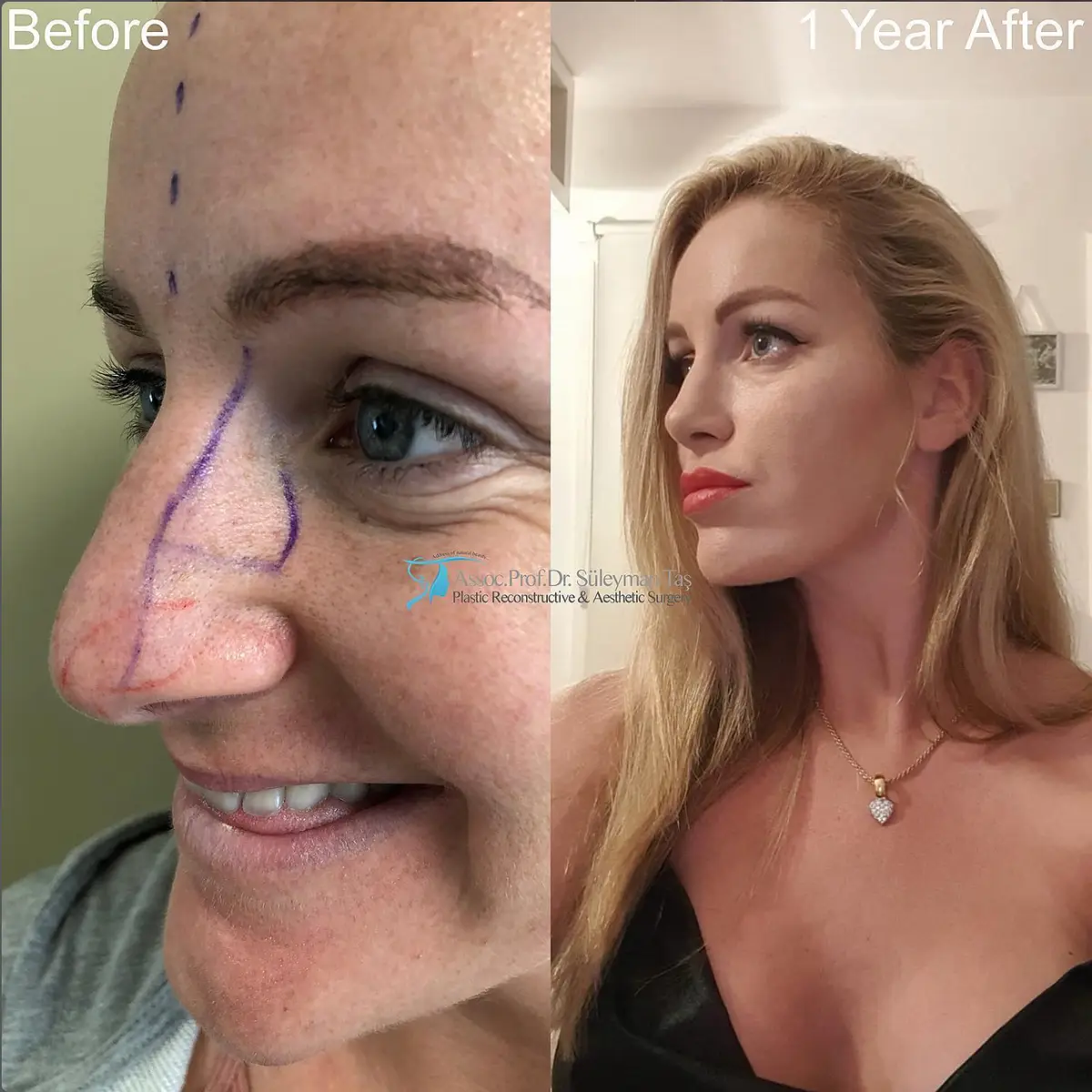Suleyman Tas reviews – verified rhinoplasty patient review #96