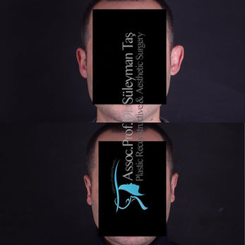 Otoplasty (Ear Pinning) before and after photo of a male patient, front view, by Prof. Dr. Süleyman Taş, plastic surgeon in Istanbul