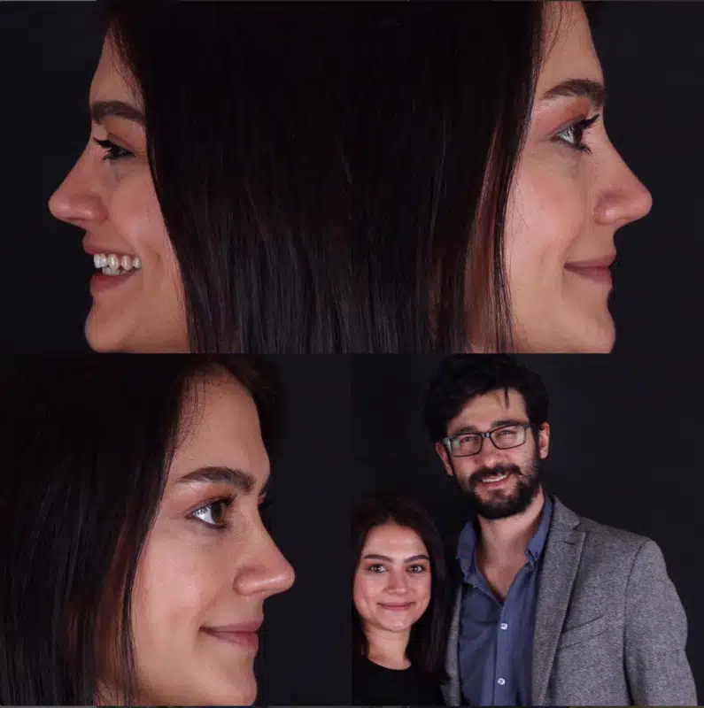 Suleyman Tas reviews – verified rhinoplasty patient review #239